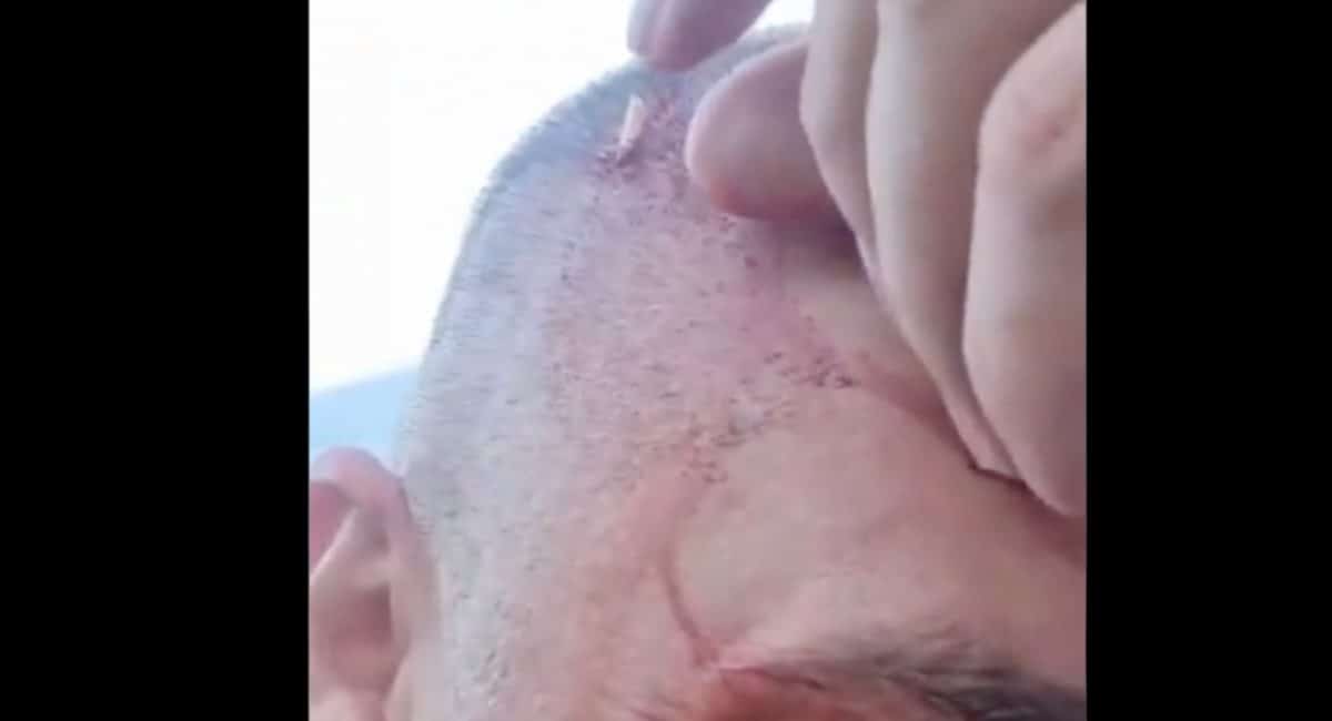 Durban man discovers shark tooth lodged in his head